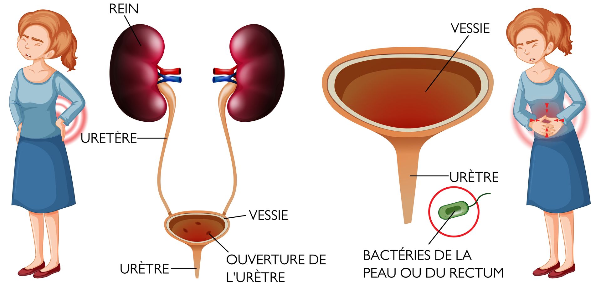 Cystite : Infection du système urinaire